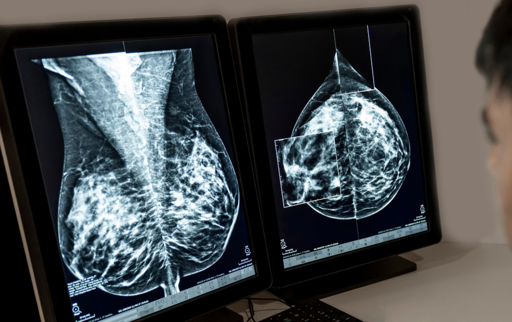 A radiologist reviews a mammogram